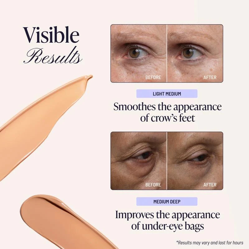 Illustrative before and after appearance of under-eye lines
